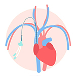 Catheter removal and wound closure - one of the procedure step in TAVI/TAVR Surgery in Mumbai