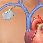 Guiding catheter insertion - one of the procedure step in TAVI/TAVR Surgery in Mumbai