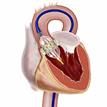 Valve assessment and adjustment - one of the procedure step in TAVI/TAVR Surgery in Mumbai