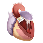 Valve deployment - one of the procedure step in TAVI/TAVR Surgery in Mumbai