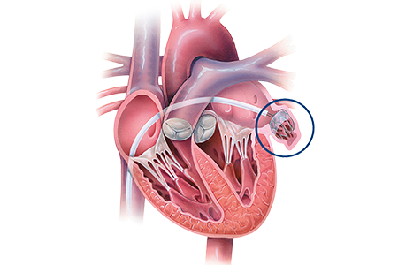 TAVI / TAVR Surgery in Mumbai 